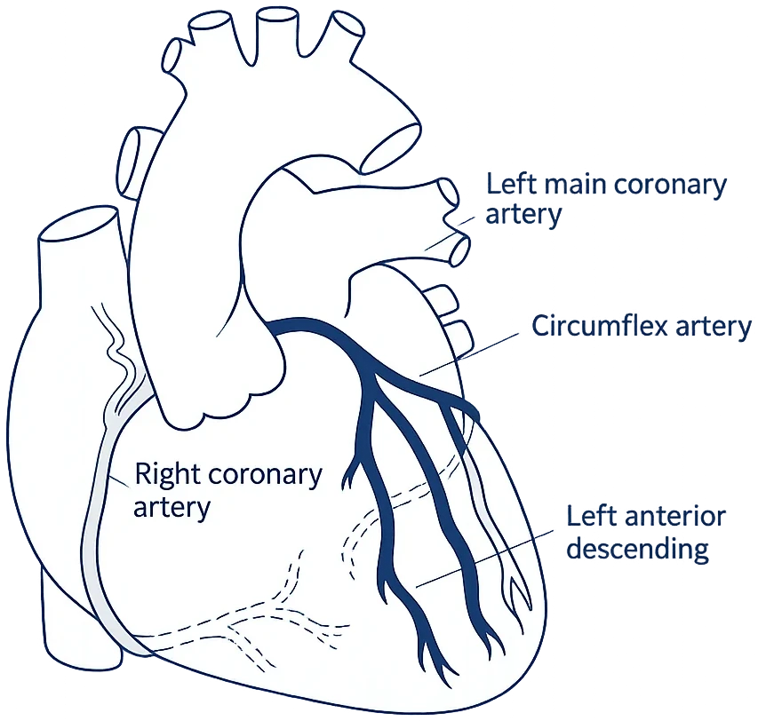 Patient-facing clinical illustration of coronary artery anatomy