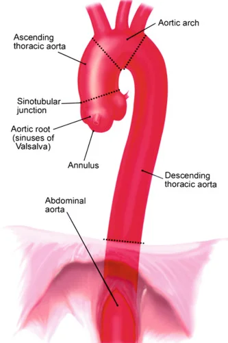 Clinical illustration of aortic anatomy