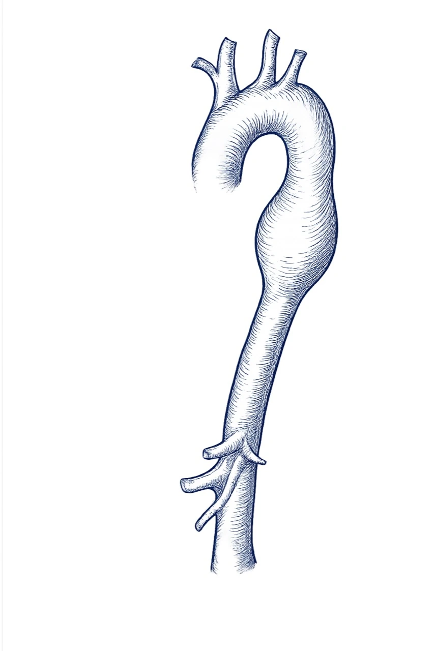 Clinical illustration of a descending aortic aneurysm