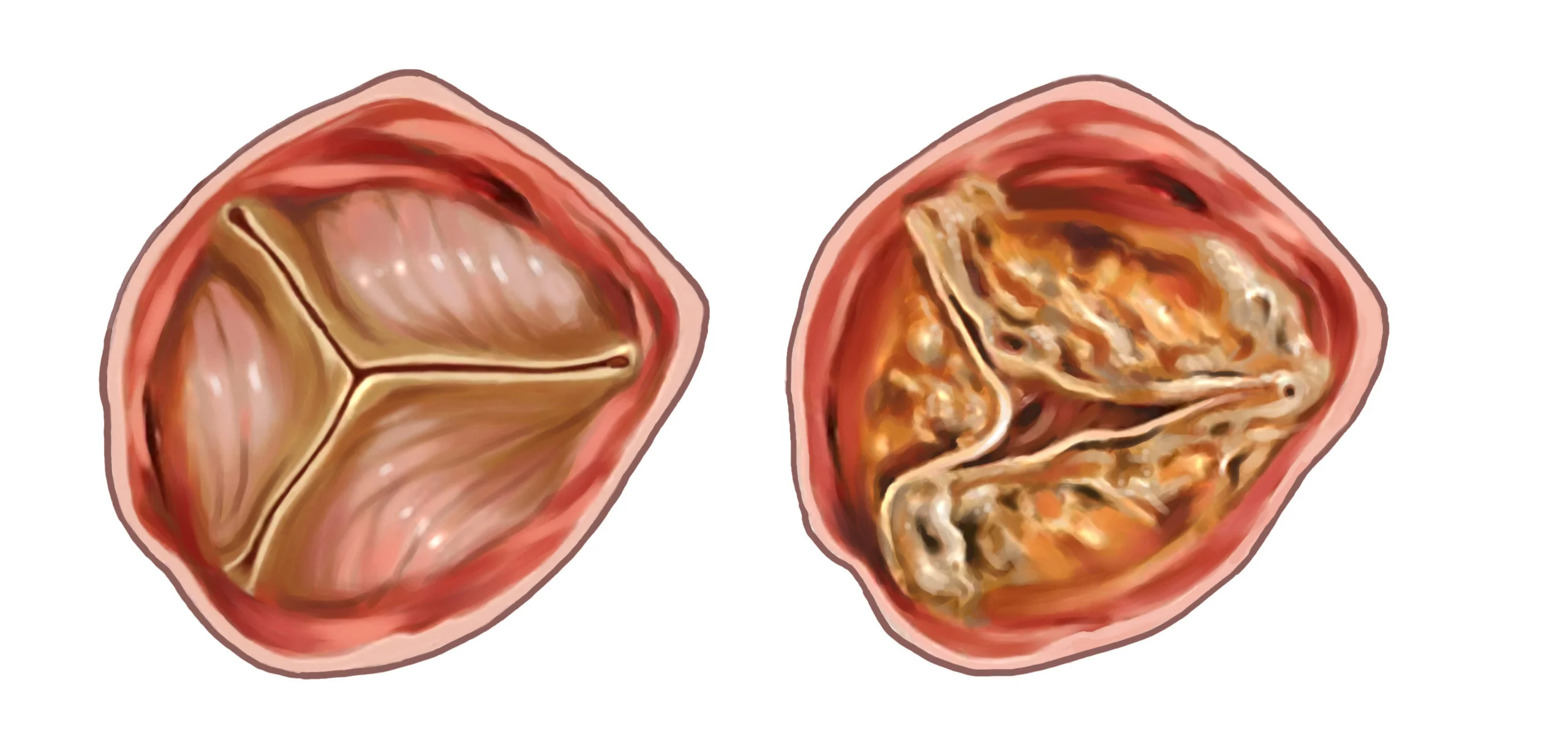 Clinical illustration of aortic valve stenosis