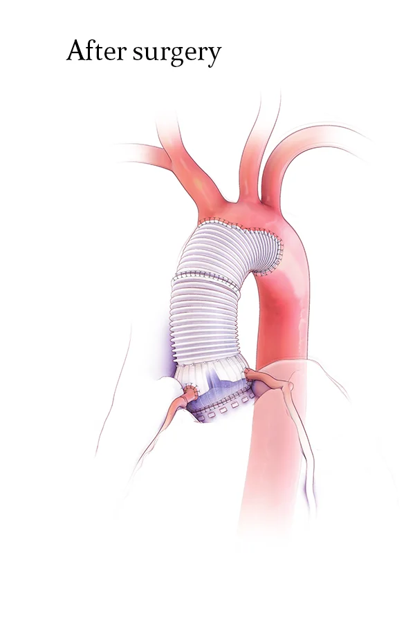 Clinical illustration of composite-graft aortic root replacement