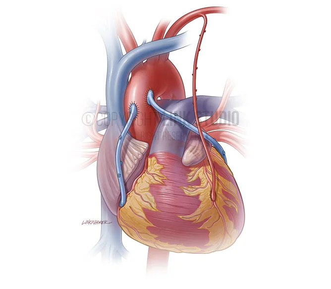 High-resolution illustration of coronary bypass grafting anatomy