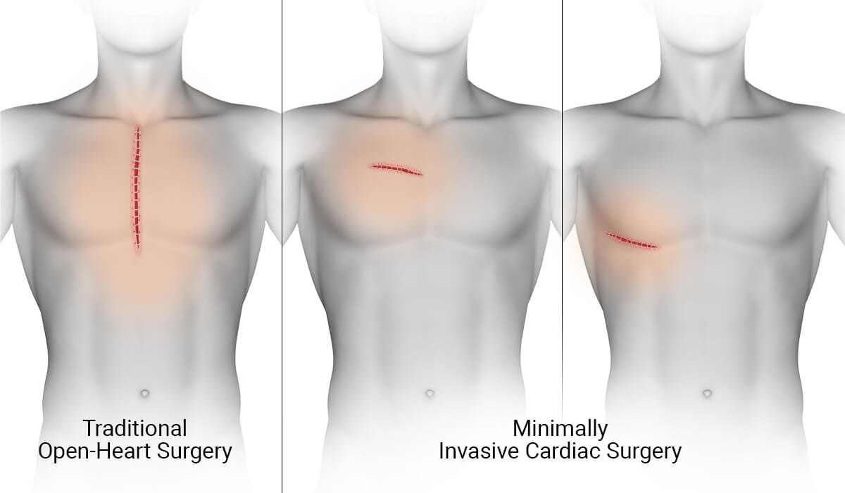 Clinical illustration comparing heart surgery incision approaches