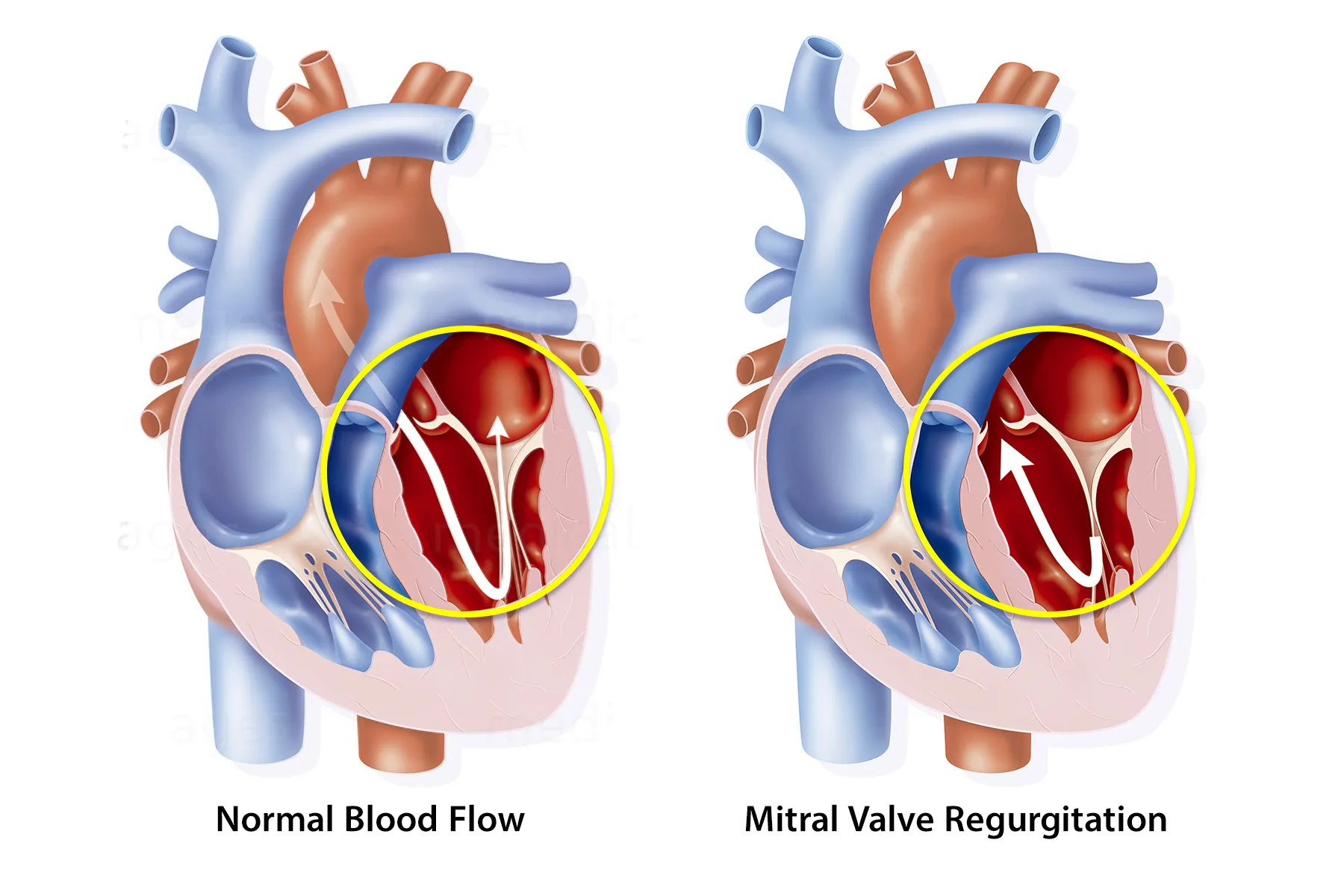 Clinical illustration of mitral valve regurgitation