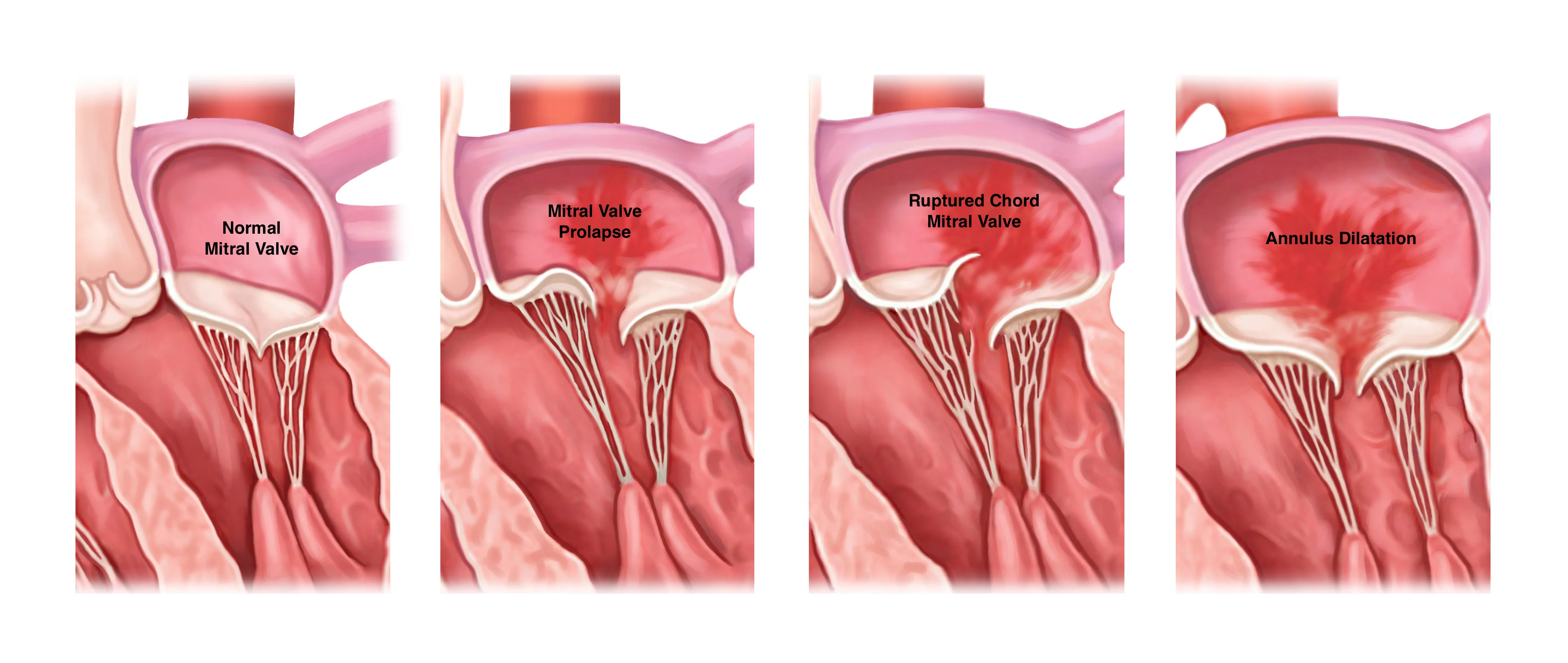 Clinical illustration of mitral regurgitation anatomy