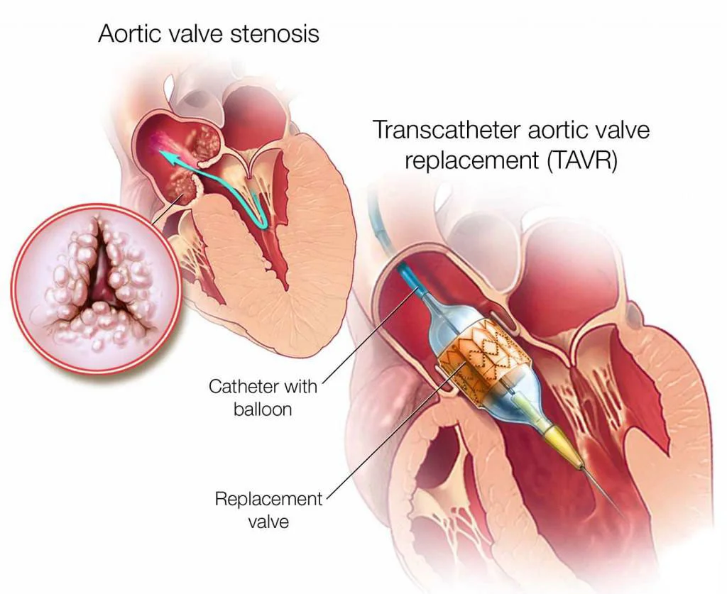 Clinical illustration of transcatheter aortic valve replacement