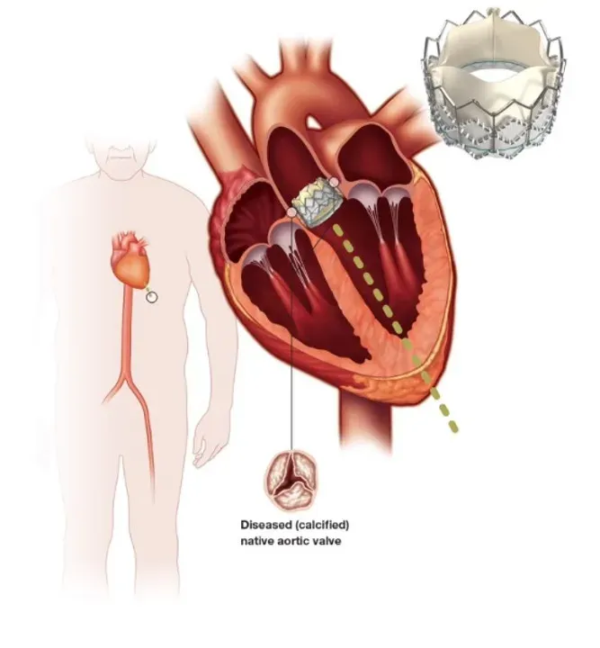 Illustration of transcatheter aortic valve replacement