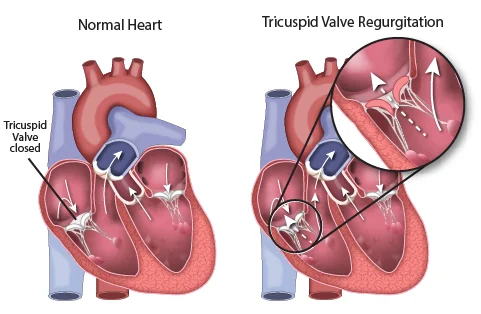 Clinical illustration of tricuspid valve regurgitation