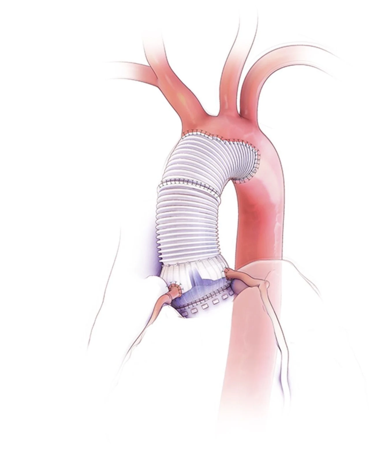 Aortic graft anatomy illustration
