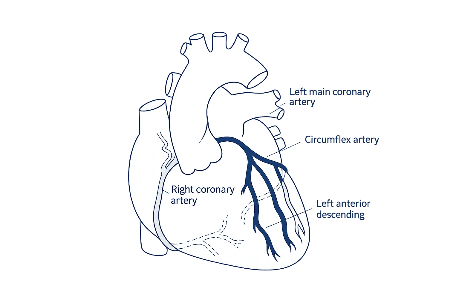 Coronary artery anatomy illustration