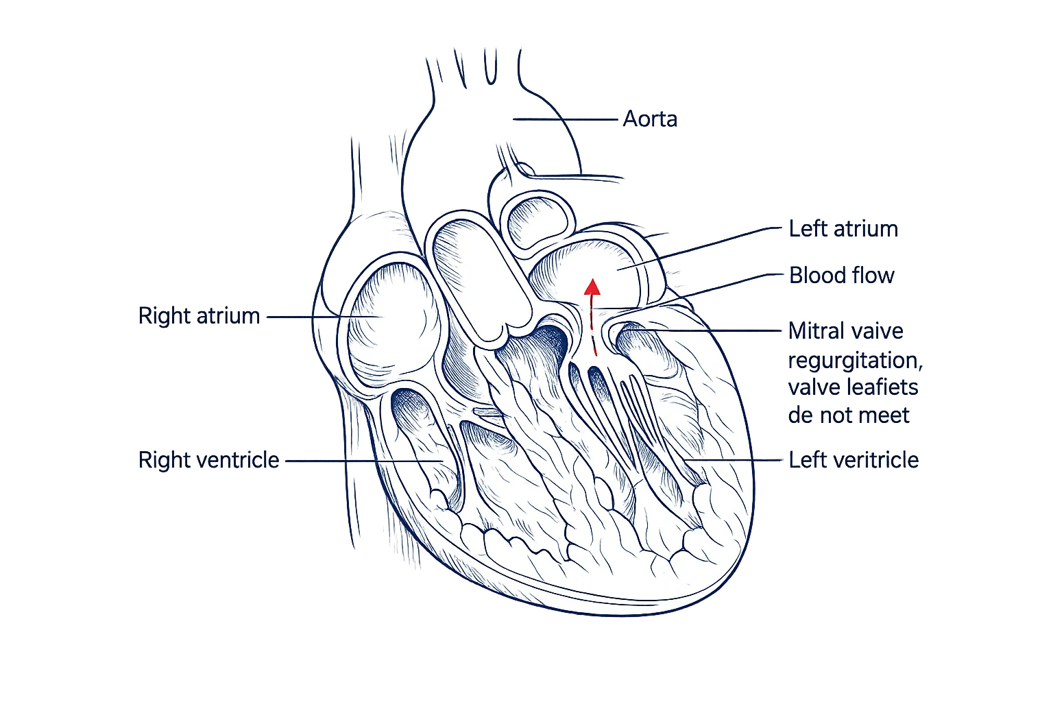 Mitral regurgitation anatomy illustration